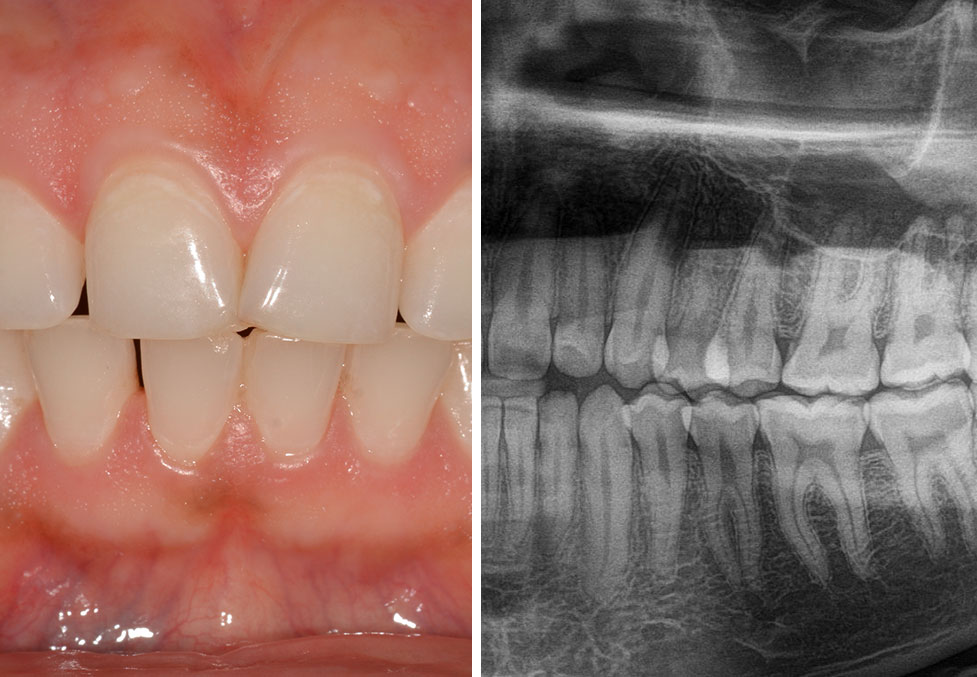 Annual Dental Check-up and Cleaning