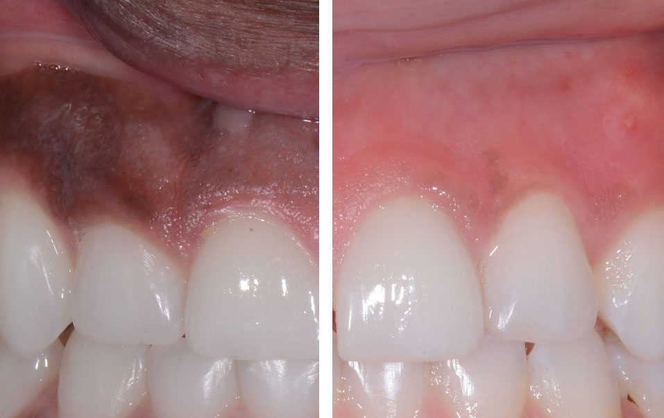 Gum Depigmentation