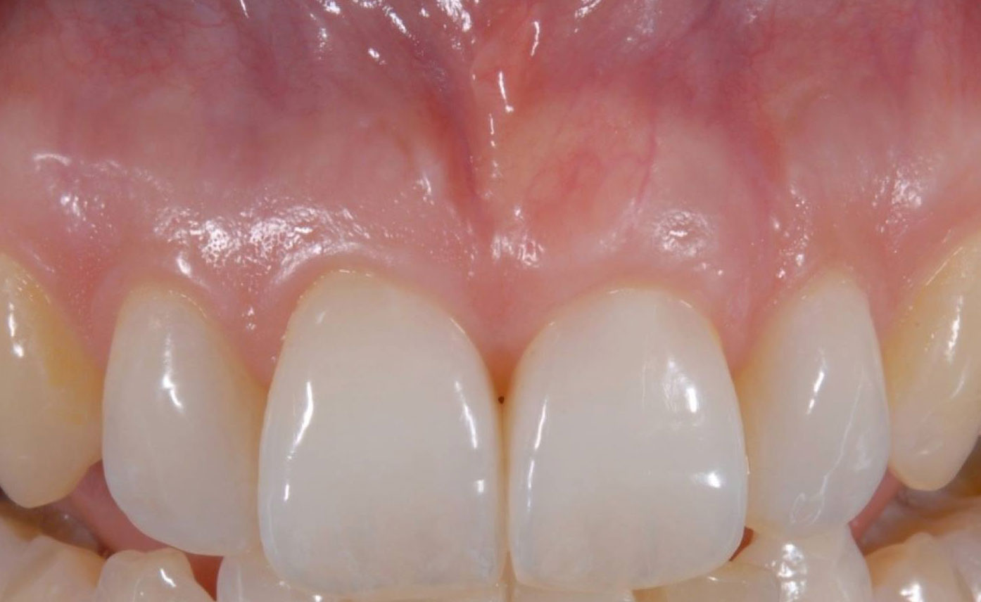 Mucogingival Esthetic Surgery