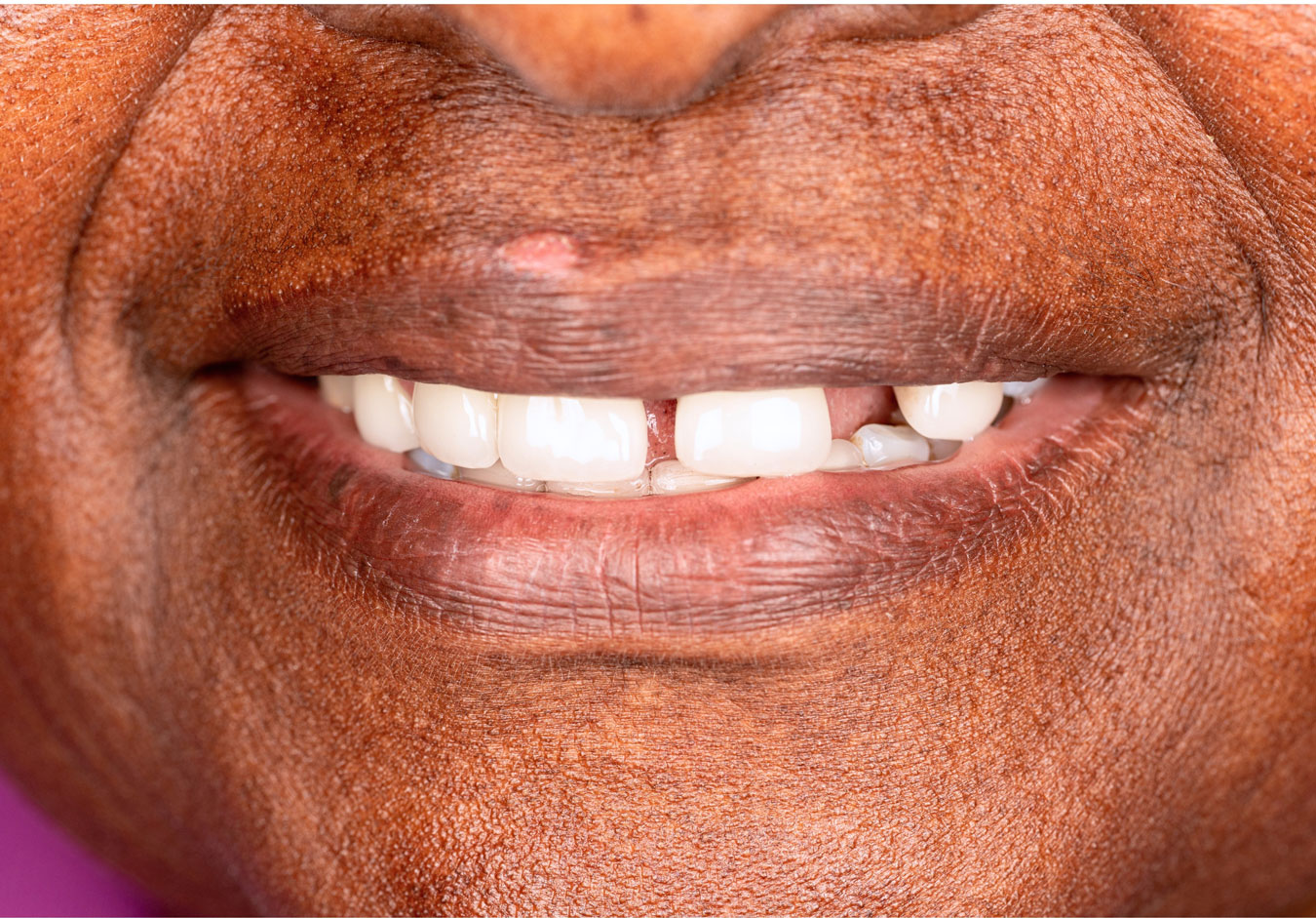Close-up of a smile, showing a set of teeth and a visible missing front tooth.
