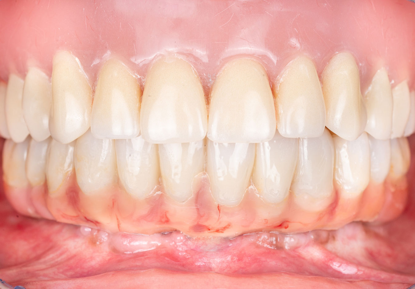 Intraoral view of an ALL-ON-4 implant bridge.