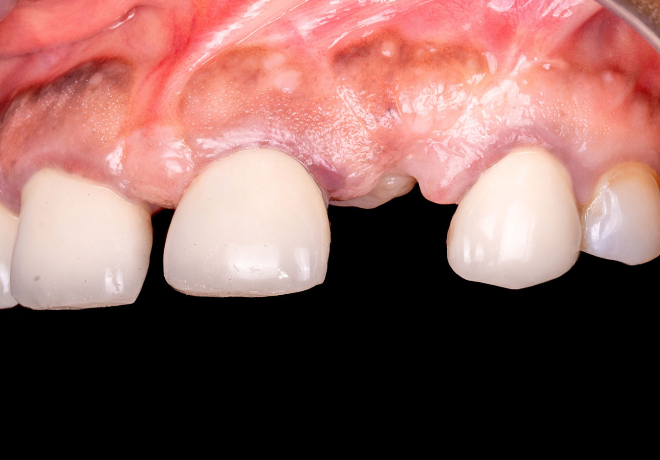 Close-up of an Intraoral section of the mouth showing missing a tooth.