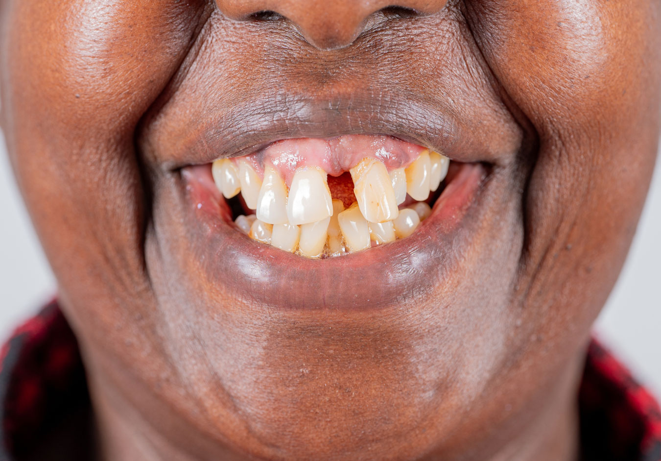 Close-up of a smile showing teeth affected by gum disease.