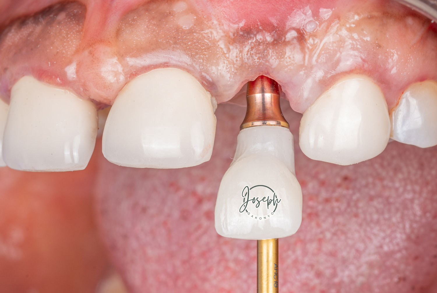 Dental Implants