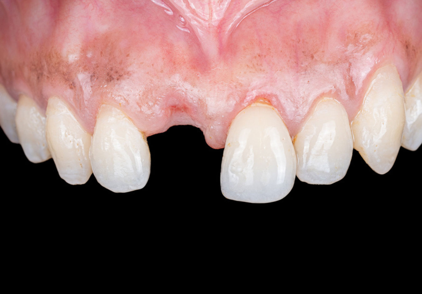 Close-up of an Intraoral section of the mouth showing missing a front tooth.