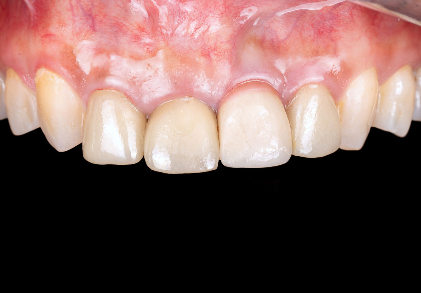 Close-up of an upper jaw showing uneven gum levels due to poorly designed old crowns combined with a gummy smile.