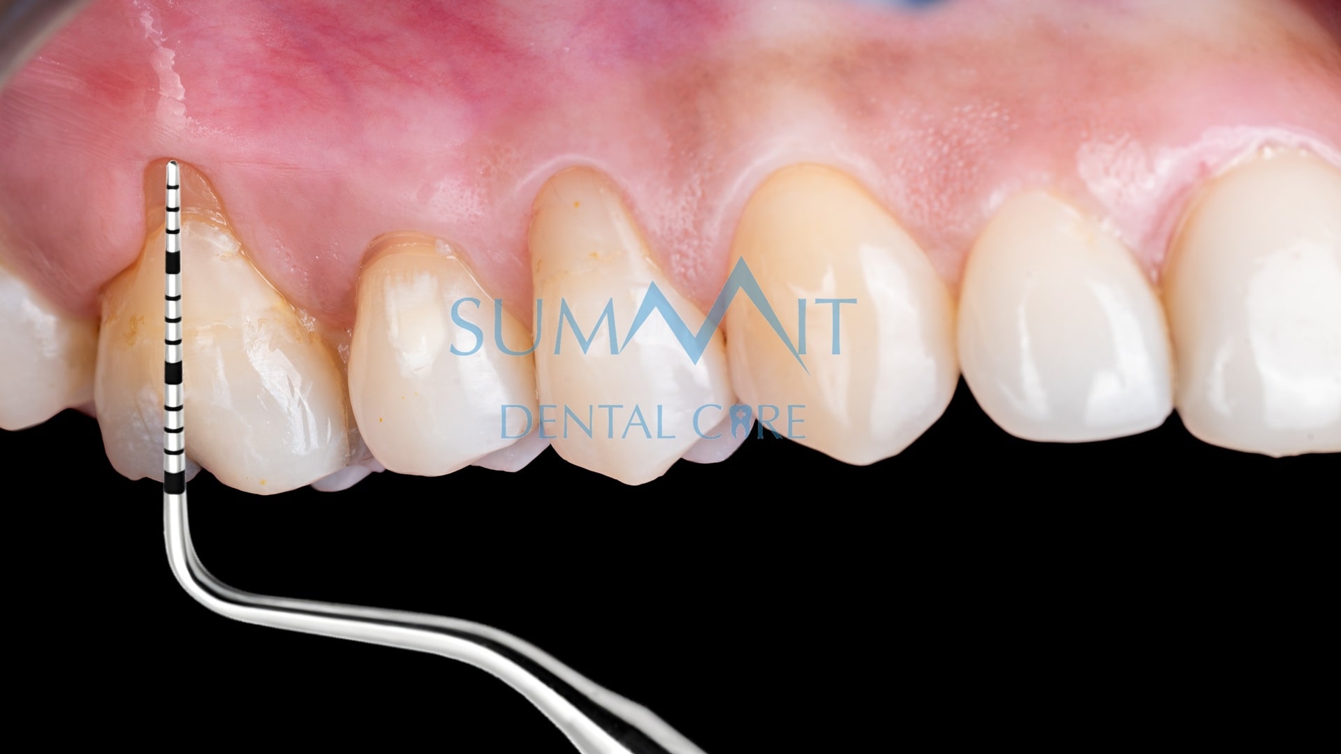 Gum Recession: Causes, Prevention, Surgery & Treatment - Summit Dental Care