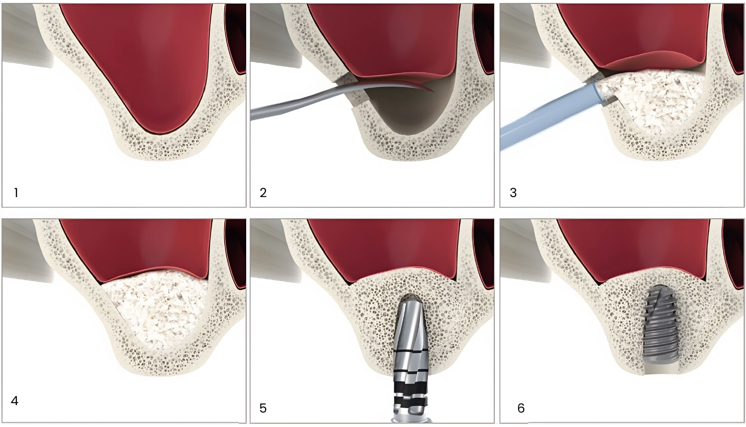 An animated sinus lift procedure.