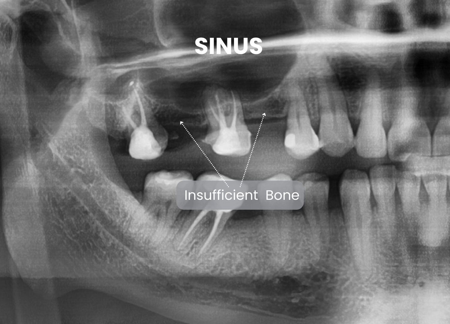 An X-ray showing the Sinus area with sufficient bone loss shown using arrows.