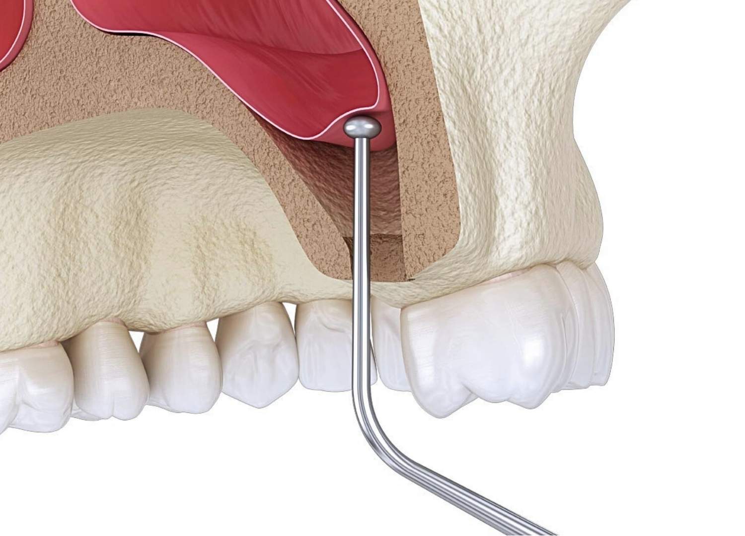 A 3D illustration of a sinus lift procedure